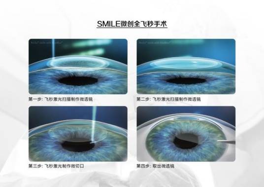 飞秒激光(一种用于眼科手术的激光技术)