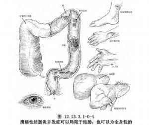 感染性肠道疾病的直肠结肠切除术