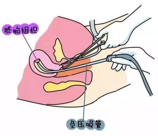 安全人工流产