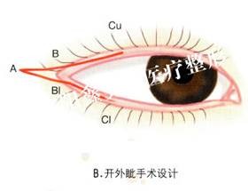 外眦开大术