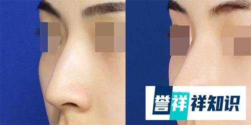 韩国做一个鼻综合整形手术大概多少钱?4万够不够？