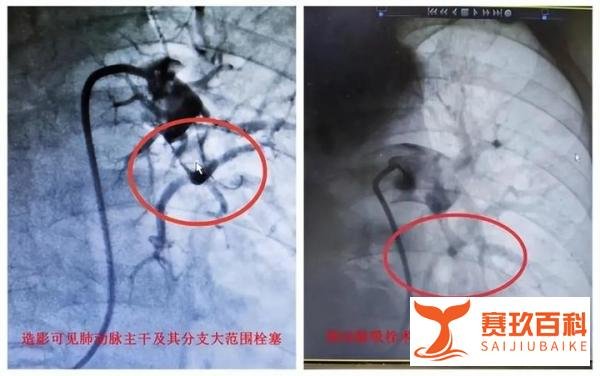 阳性一个月后肺栓塞风险增加33倍与日本一个多月内新冠死亡病例逾万