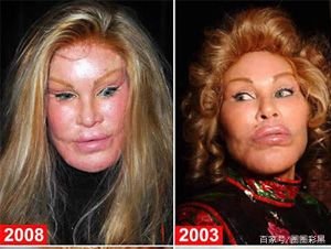 整容的风险很高,都有哪些明星因整容失败而毁容呢?