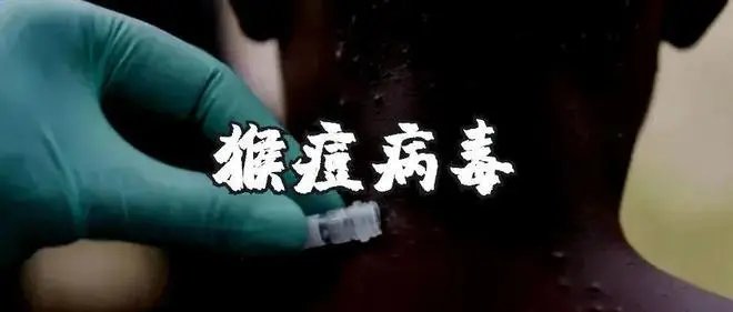 猴痘病毒已在美国境内蔓延,感染这种病毒后会对身体机能有何影响?
