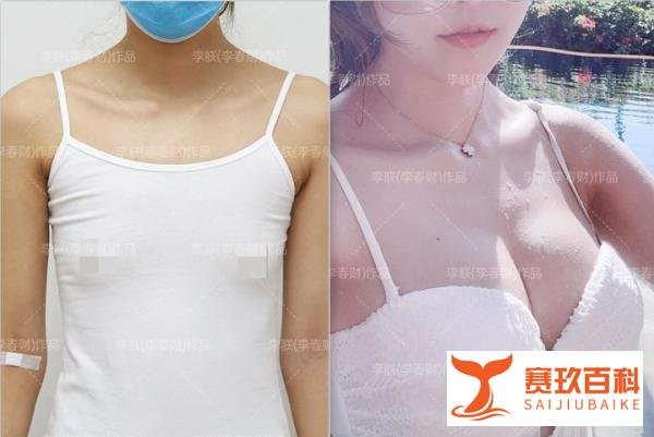 圣嘉新李春财（李朕）科普：自体脂肪丰胸能维持多久？