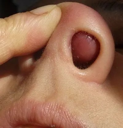 慢性鼻炎症状表现?