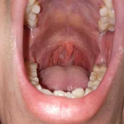 舌头开裂是什么原因?