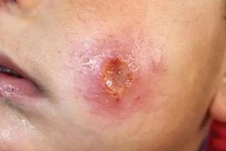 皮肤利什曼病面部症状图片