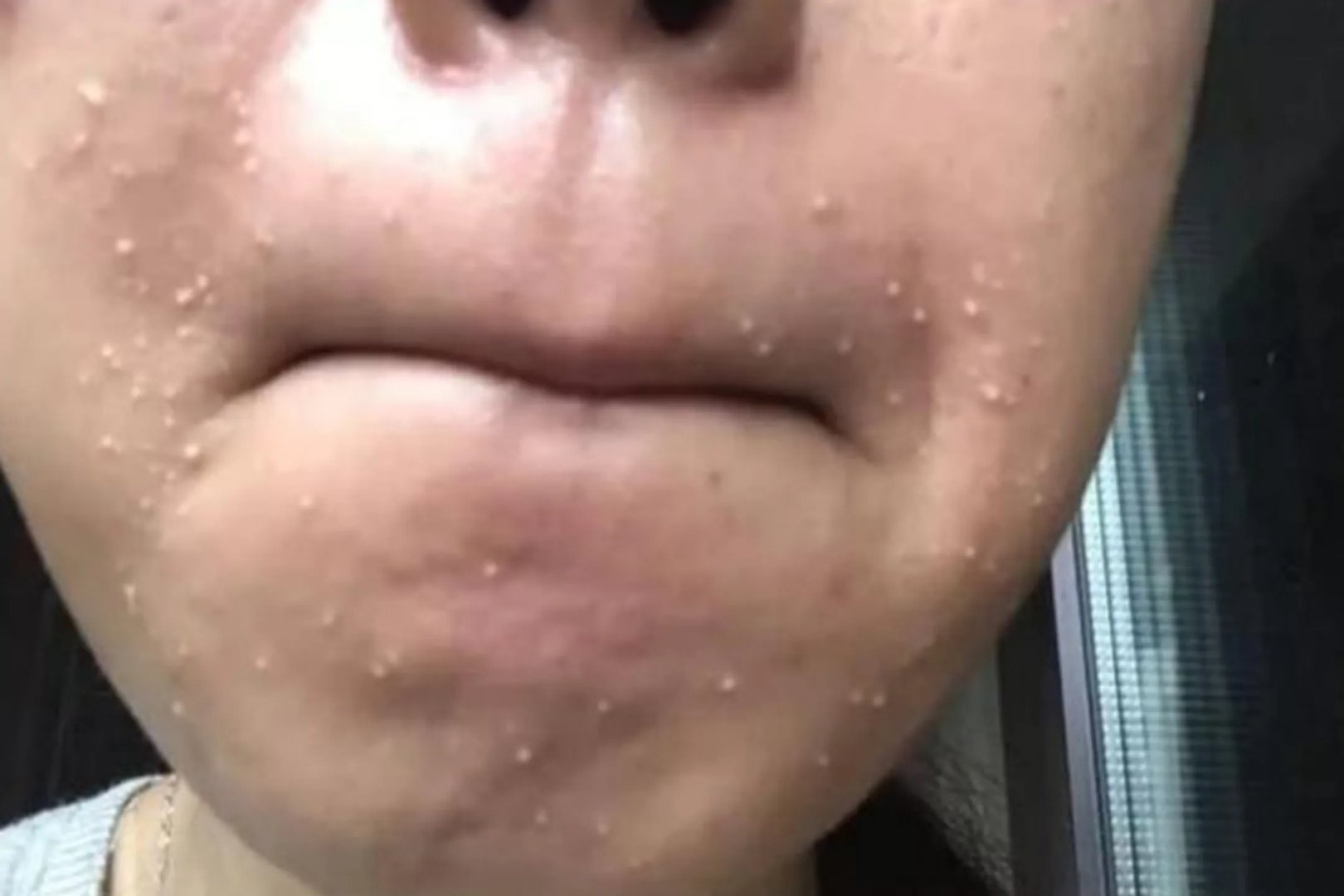 什么是白头粉刺图片