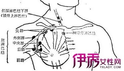 颈部淋巴癌早期图片
