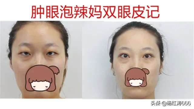 割双眼皮到底好不好?