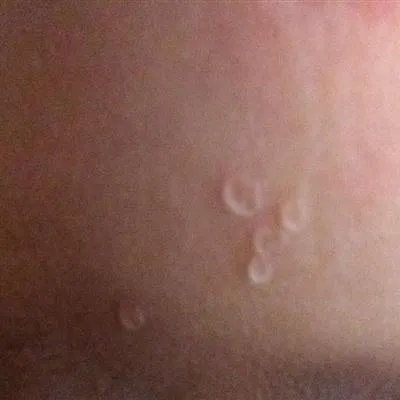 扁平疣症状