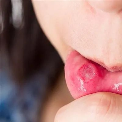 经常口腔溃疡怎么办