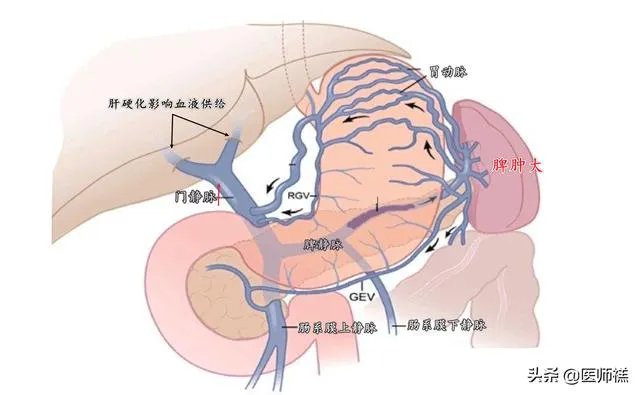 肝硬化前兆有哪些症状?