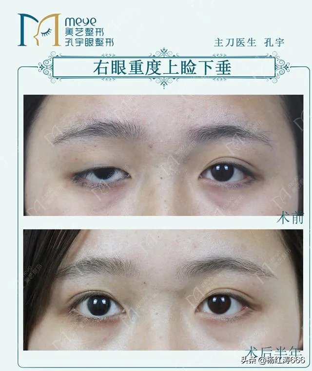 割双眼皮到底好不好?