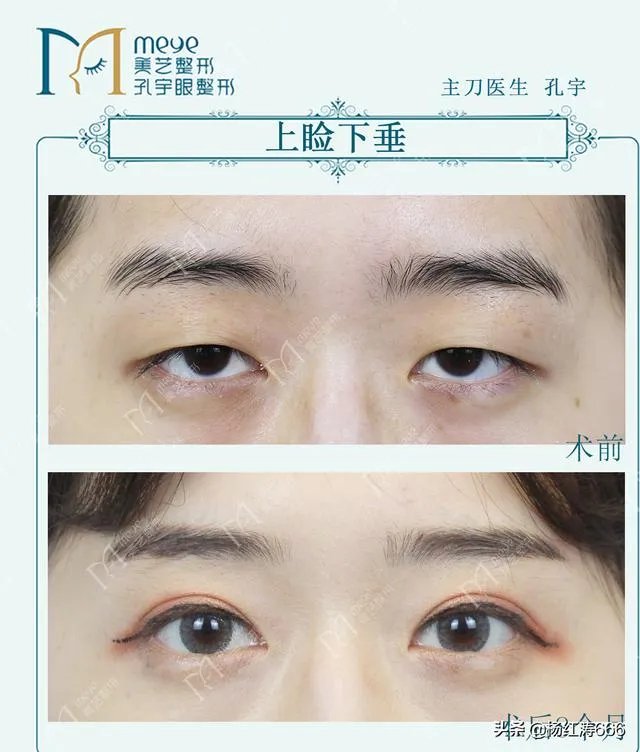 割双眼皮到底好不好?