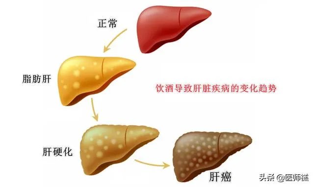 肝硬化前兆有哪些症状?