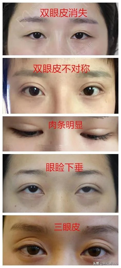 割双眼皮到底好不好?