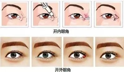 开眼角手术前后的注意事项是哪些?