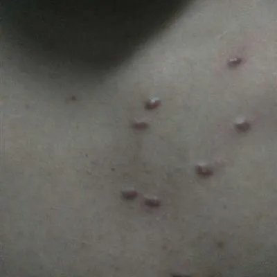 扁平疣症状