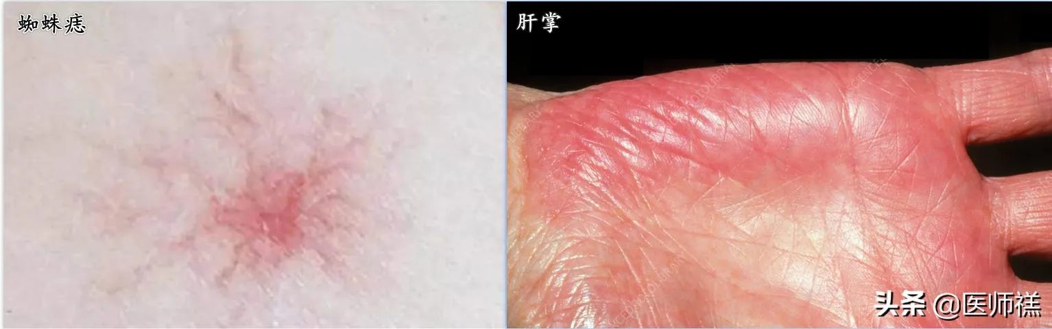 肝硬化前兆有哪些症状?