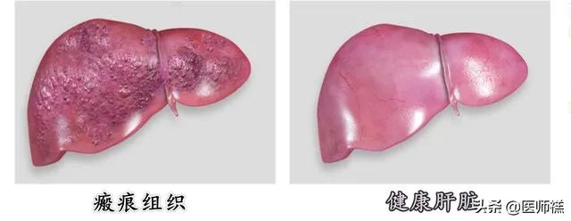 肝硬化前兆有哪些症状?