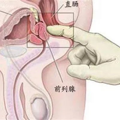 前列腺稍大怎么回事?