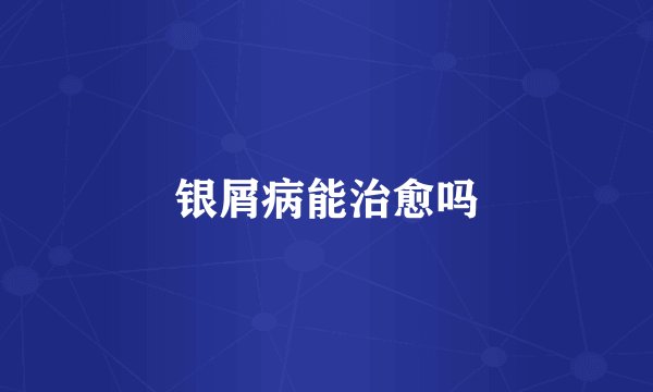 银屑病能治愈吗
