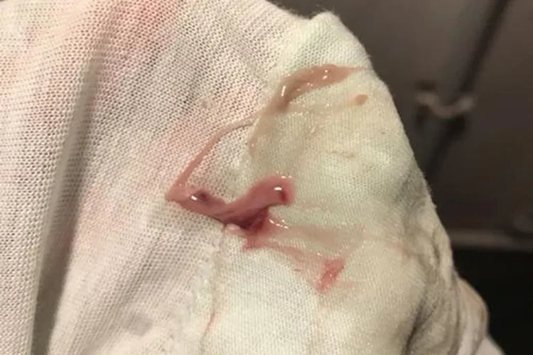 宫颈癌内裤分泌物图片