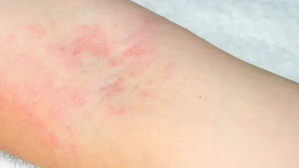 皮炎和湿疹的区别是什么