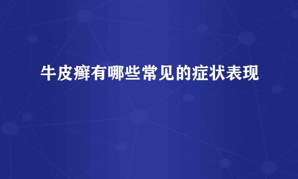 牛皮癣有哪些常见的症状表现