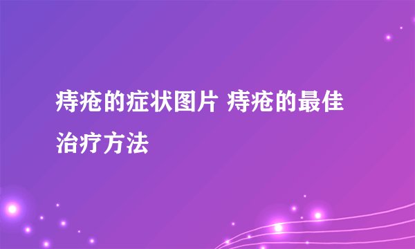 痔疮的症状图片 痔疮的最佳治疗方法