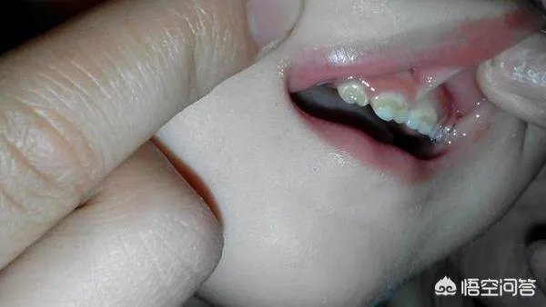 牙釉质发育不良能洗牙吗？