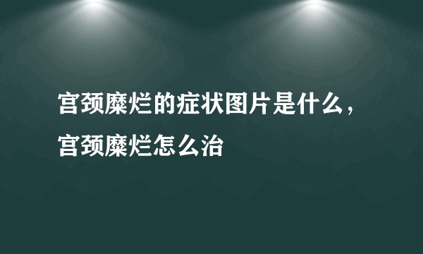 宫颈糜烂的症状图片是什么，宫颈糜烂怎么治