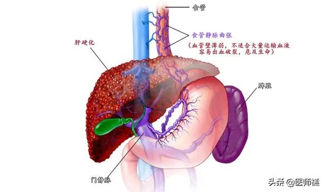 肝硬化前兆有哪些症状?