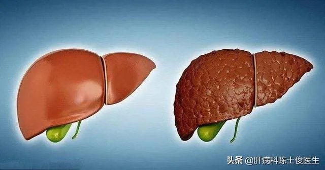 肝硬化前兆有哪些症状？