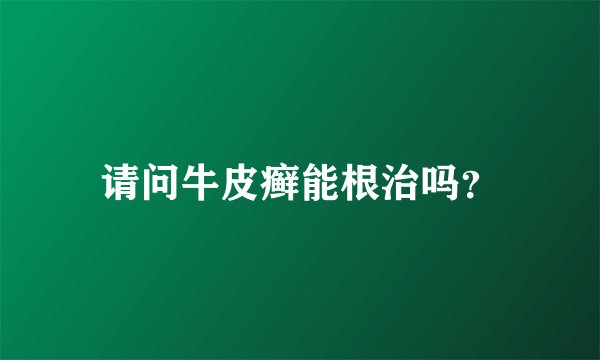请问牛皮癣能根治吗?
