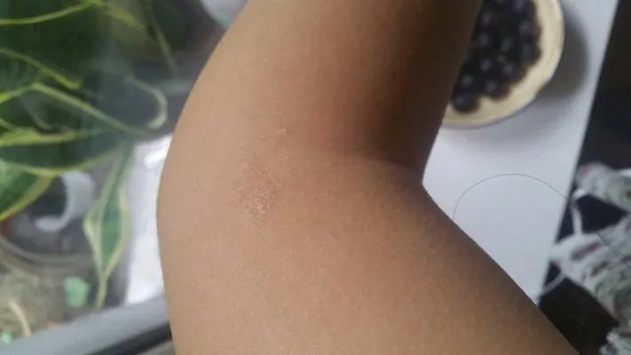 宠物真菌皮肤病症状?