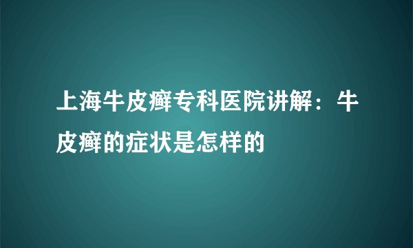 上海牛皮癣专科医院讲解：牛皮癣的症状是怎样的